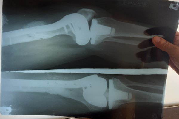 Phương pháp mới giảm biến chứng sau cấy ghép xương