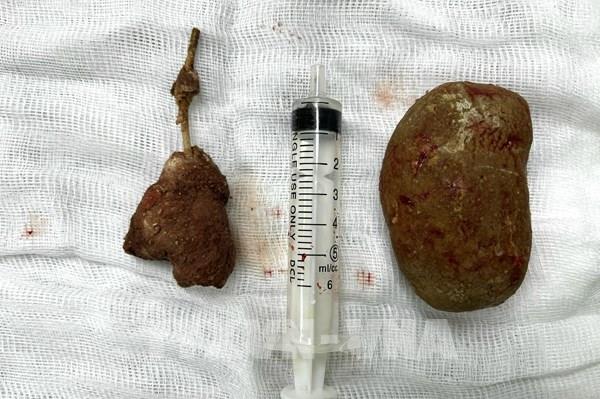 Phẫu thuật lấy thành công viên sỏi khổng lồ trong bàng quang bệnh nhân