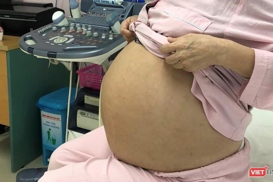 “Giải phóng” khối u nặng gần 15 kg cho cụ bà 71 tuổi