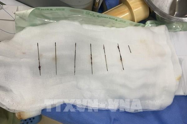 Gắp thành công 7 cây kim ra khỏi lồng ngực nữ bệnh nhân