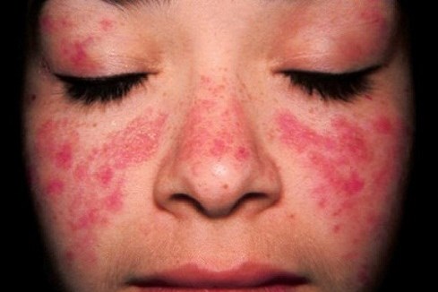 Hướng điều trị mới cho người mắc bệnh lupus ban đỏ