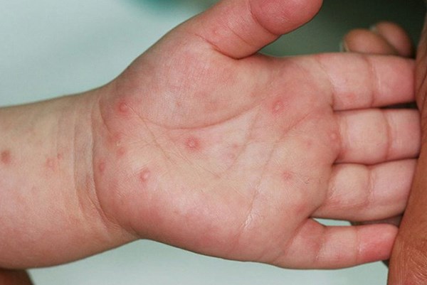 Không để dịch bệnh tay chân miệng bùng phát, lan rộng và kéo dài