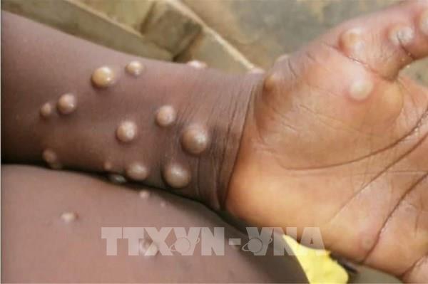 Chuyên gia y tế kêu gọi WHO và các nước ngăn chặn bệnh đậu mùa khỉ