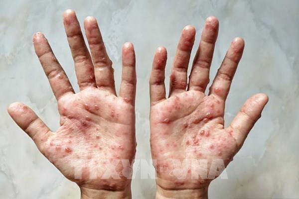 Bộ Y tế thông tin về bệnh nhân đầu tiên mắc bệnh Đậu mùa khỉ tại Việt Nam