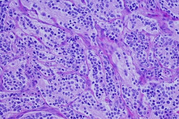 Australia thử nghiệm thuốc mới hỗ trợ điều trị ung thư tuyến tụy