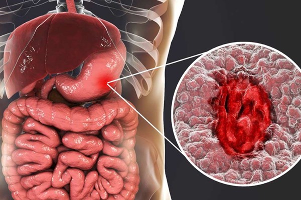 Có thể chữa khỏi ung thư dạ dày nếu phát hiện sớm