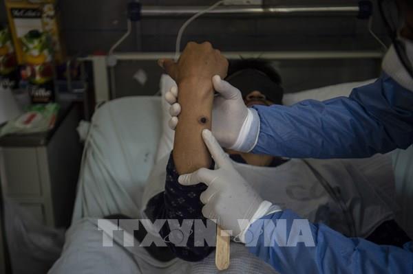 Thành phố Hồ Chí Minh ghi nhận 13 ca bệnh đậu mùa khỉ