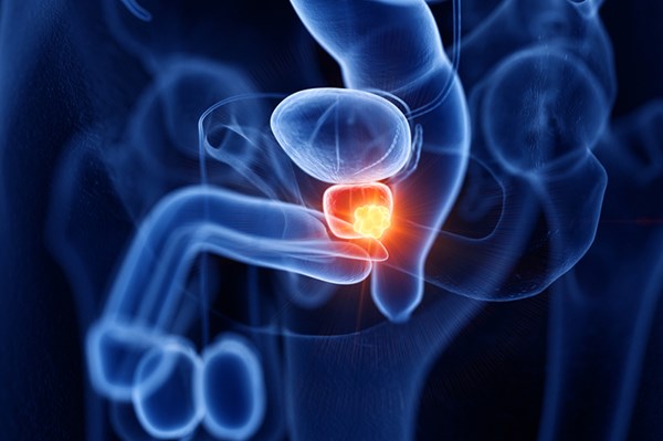 Tầm soát giúp phát hiện sớm ung thư tuyến tiền liệt