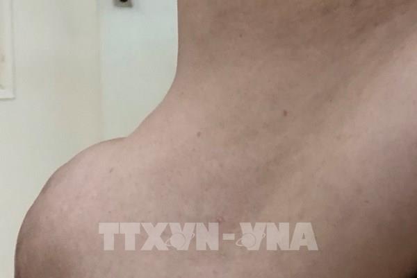 Phẫu thuật thành công bệnh nhân bị thoát vị thành bụng khổng lồ hiếm gặp