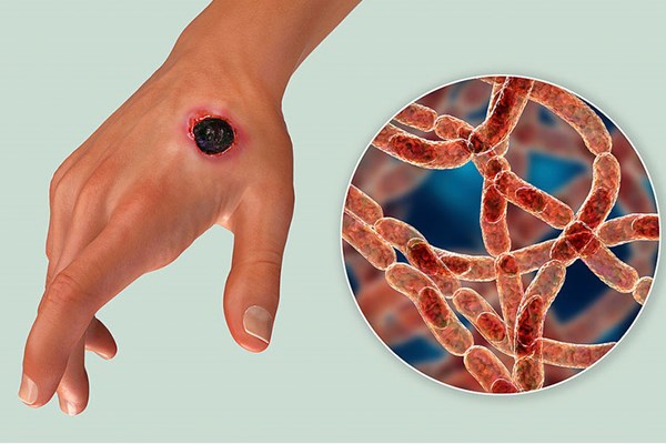 Phát hiện ổ dịch bệnh than tại Điện Biên