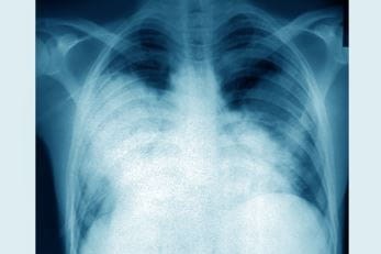 ECDC cảnh báo về dịch bệnh Legionnaire tại châu Âu