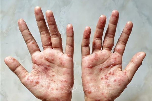 Kiên Giang ghi nhận 3 trường hợp mắc bệnh đậu mùa khỉ