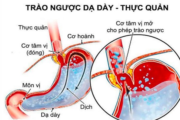 Khoảng 10 triệu người Việt Nam mắc bệnh lý trào ngược dạ dày​