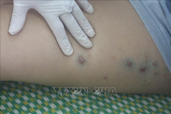 Tp Hồ Chí Minh: Nhiều người dân khổ sở vì kiến ba khoang trong mùa mưa​