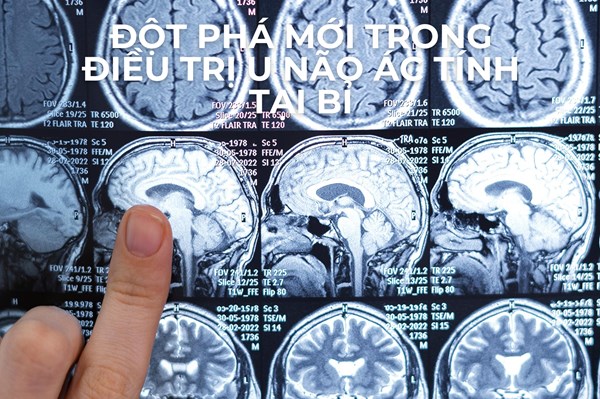 Đột phá mới trong điều trị u não ác tính tại Bỉ