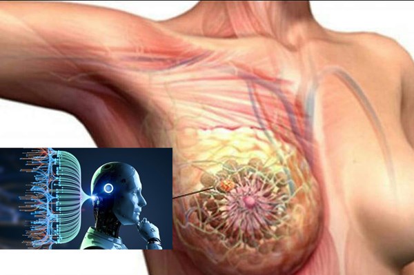 Ứng dụng AI để phát hiện ung thư vú qua chụp nhũ ảnh