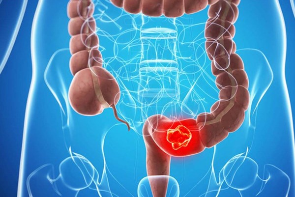 Ung thư đại trực tràng gia tăng ở người dưới 50 tuổi