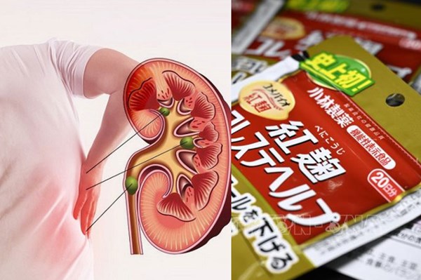 Thực phẩm men gạo đỏ của Kobayashi gây tổn thương thận kéo dài
