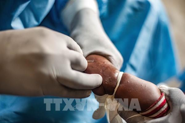 WHO tiếp tục cảnh báo nguy cơ từ bệnh đậu mùa khỉ tại châu Phi