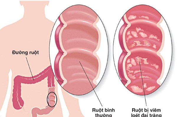 Giải pháp giảm nguy cơ tái phát viêm loét đại tràng