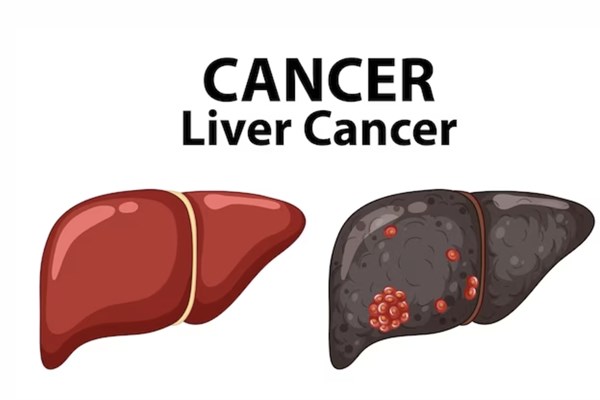 Dự đoán chính xác hơn 80% sự tái phát ung thư gan nhờ AI