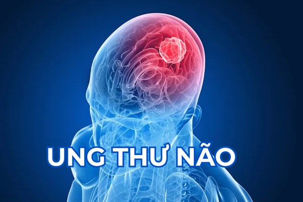 Triển vọng thuốc điều trị ung thư não của Trung Quốc