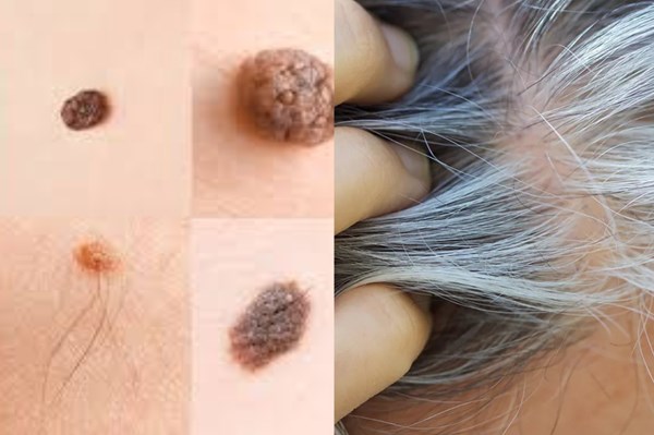 Mối liên quan giữa tóc bạc và nguy cơ ung thư